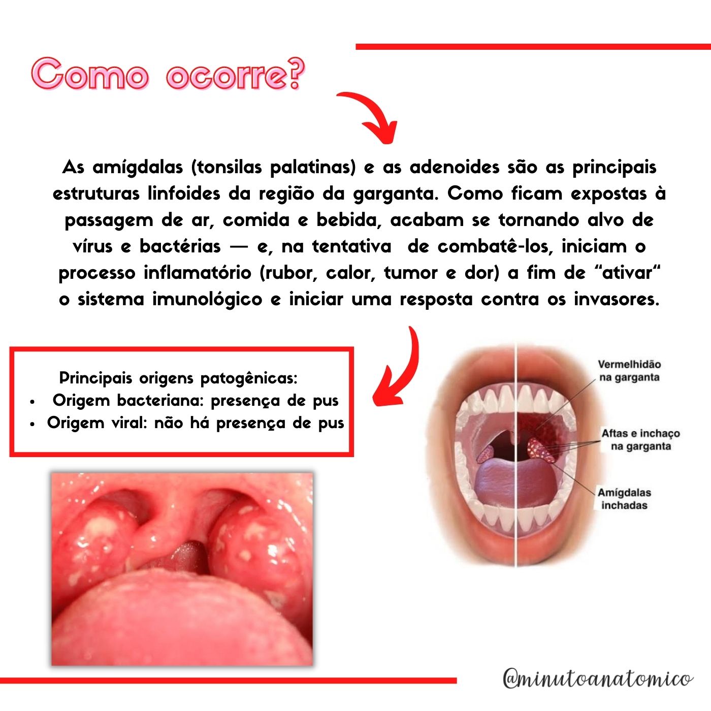 Minuto anatômico #132: Por que a garganta inflama? – Anatomia ...