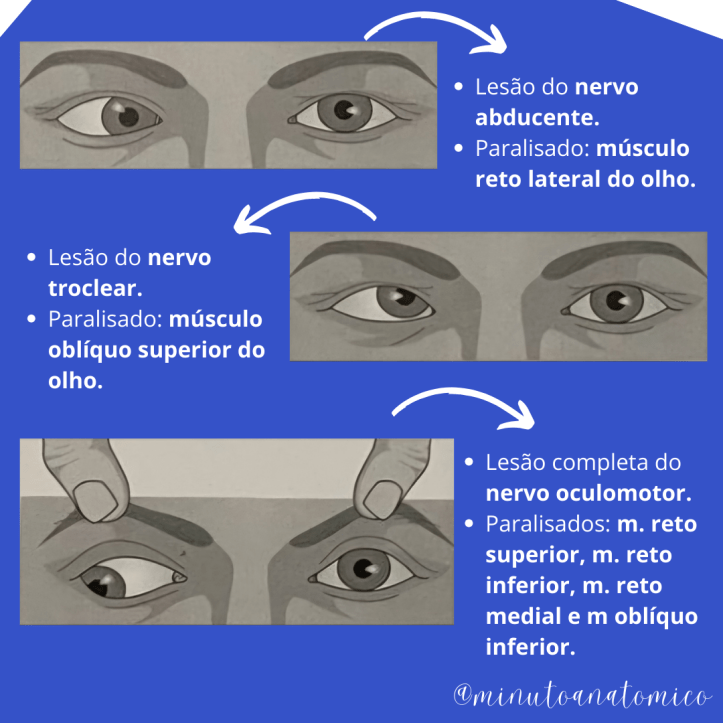 Minuto Anatômico #203: Paralisias oculomotoras – Anatomia & Fisioterapia