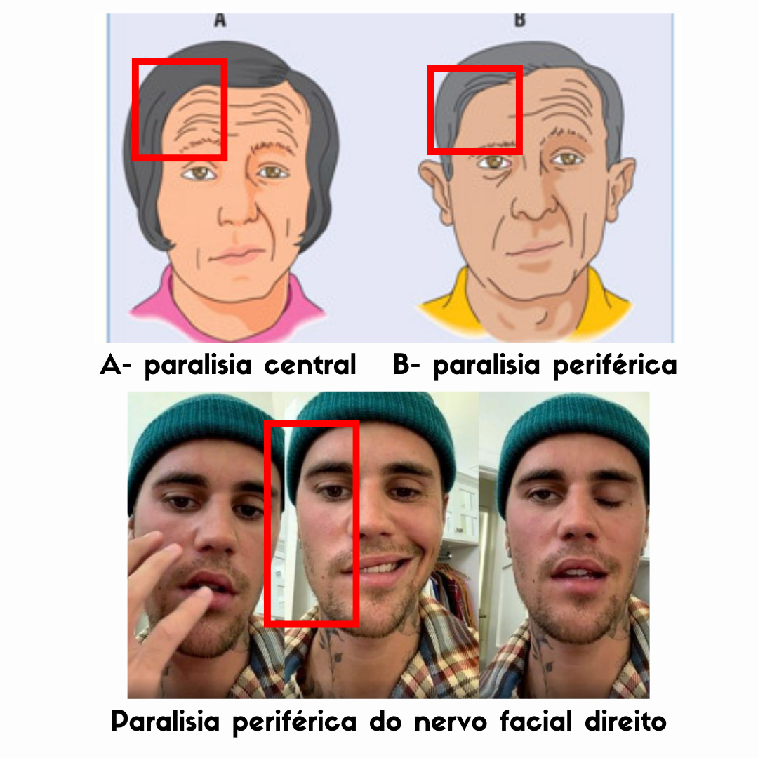 Minuto Anatomoclínico #49: Paralisia do nervo facial – Anatomia ...