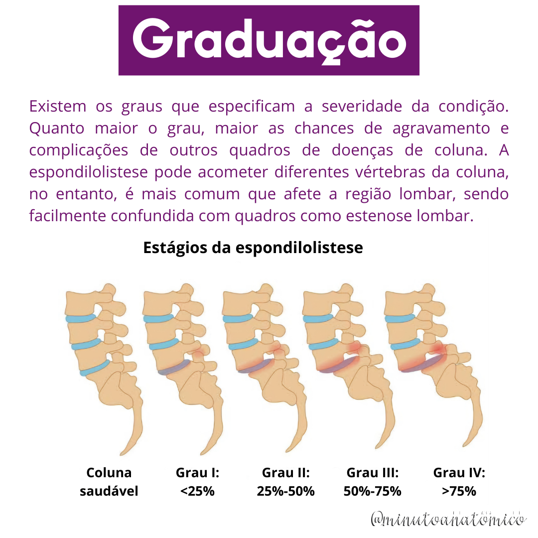 Minuto Anatômico #214: Você sabe o que é espondilolistese? – Anatomia ...