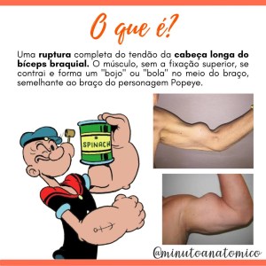 Minuto Anatomocl nico 93 Sinal Do Popeye Anatomia Fisioterapia minuto-anatomocl-nico-93-sinal-do-popeye-anatomia-fisioterapia